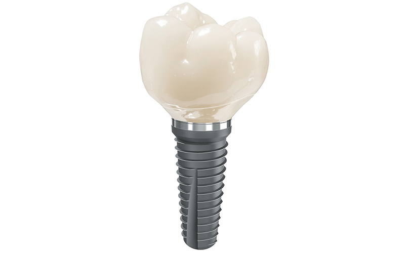 dental implant, tooth, Darlene Sand Wall, dentistry