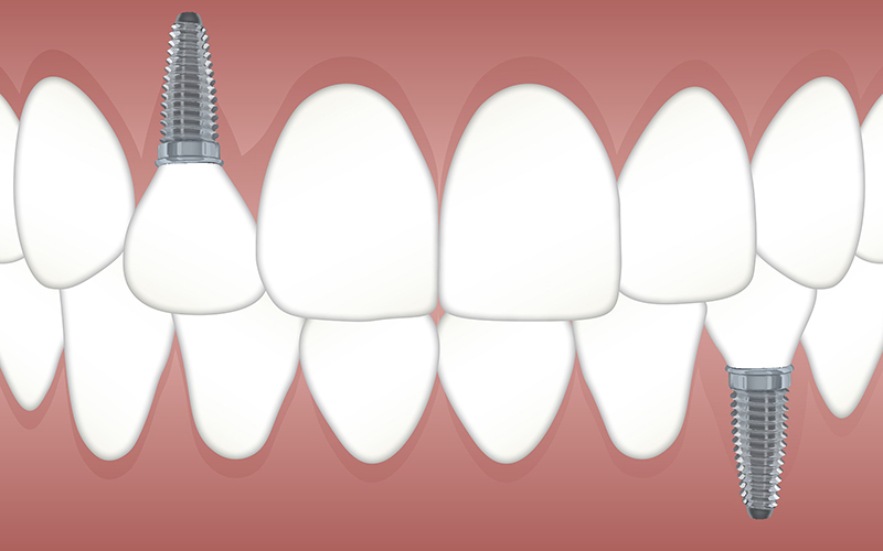 dental implants, teeth, illustration, Darlene Sand Wall DMD, dentistry