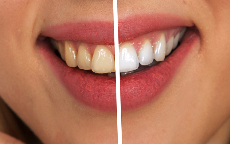 teeth, whitener, Darlene Sand Wall DMD, dentistry
